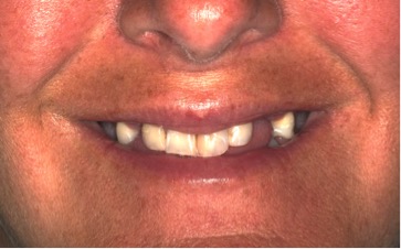 before pic of replacing teeth