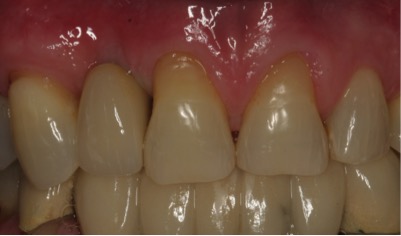 after pic of dental implant