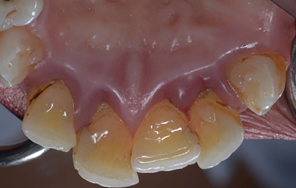 mouth suffering from periodontitis